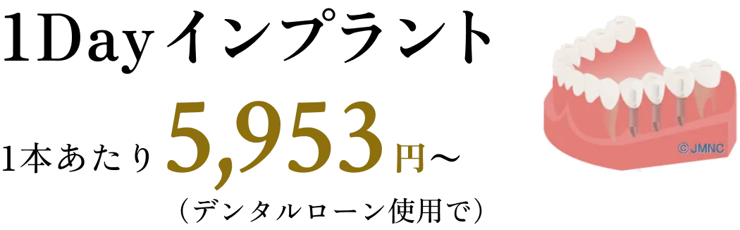 1Dayインプラント 1本あたり5,953円～（デンタルローン使用で）